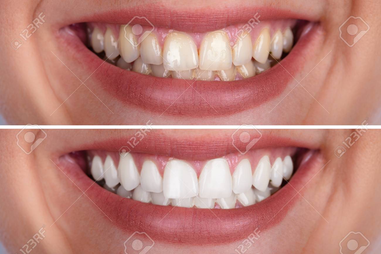 Close-up Of A Smiling Woman's Teeth Before And After Whitening - 108385047 Close-up Of A Smiling Woman's Teeth Before And After Whitening - 108385047