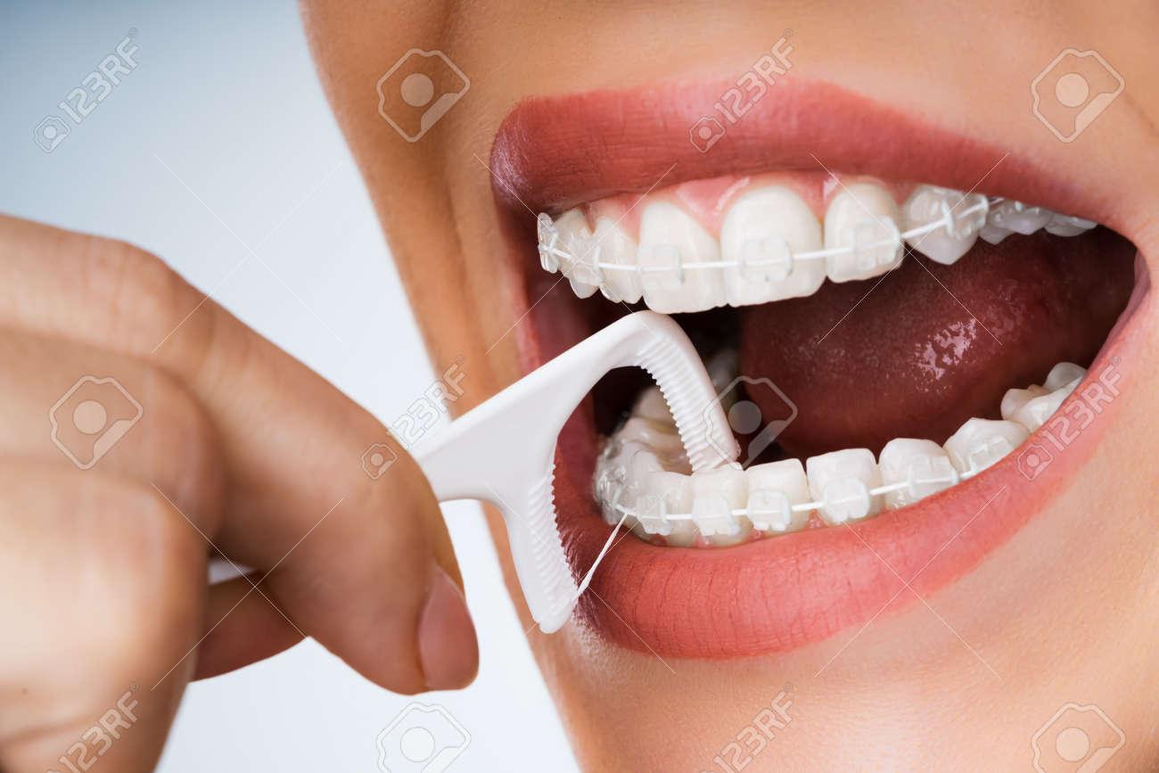 Female Cleaning Dental Brackets In Mouth Using Floss Stick - 159782097 Female Cleaning Dental Brackets In Mouth Using Floss Stick - 159782097