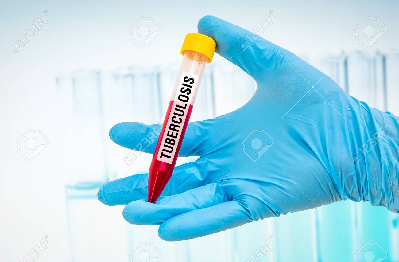 Scientists hand holding a test-tube with blood sample for TUBERCULOSIS test - 73526663 Scientists hand holding a test-tube with blood sample for TUBERCULOSIS test - 73526663