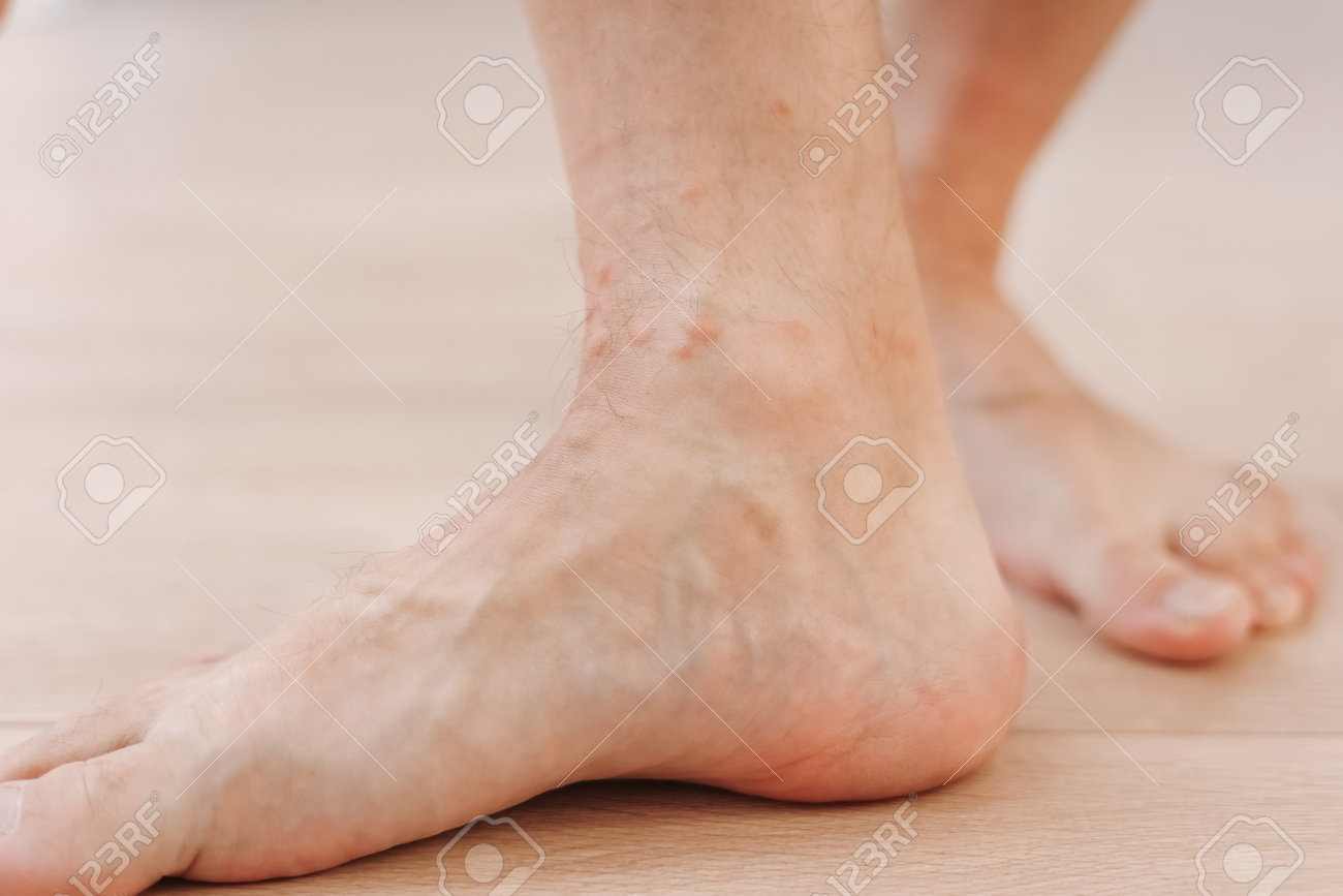 Nahaufnahme Eines Allergischen Ausschlags, Dermatitis, Ekzem Am Fuß Eines  Mannes, Mit Rotem Ausschlag, Verursacht Durch Insektenstiche, Dermatitis,  Follikulitis, Pilzinfektion, Betroffener Hautbereich, Der Rot Und Fleckig  Wird Und Anschwillt ...