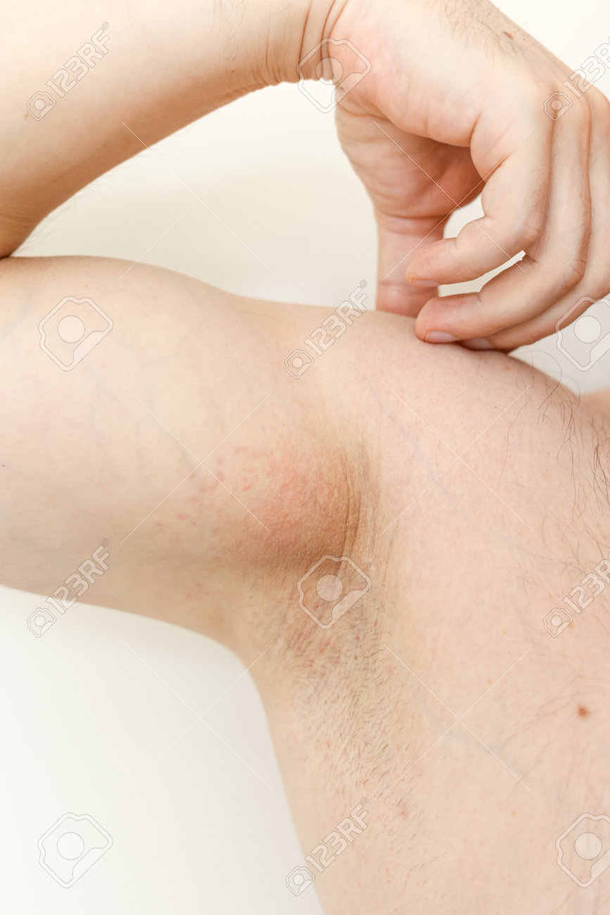 reizung unter den achseln