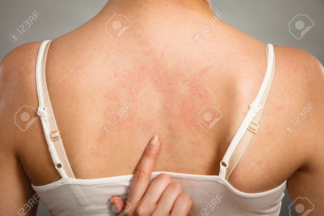 健康上の問題 皮膚病 若い女性アレルギーでかゆみ背中に発疹蕁麻疹症状を示す の写真素材 画像素材 Image 健康上の問題 皮膚病 若い女性アレルギーでかゆみ背中に発疹蕁麻疹症状を示す の写真素材 画像素材 Image