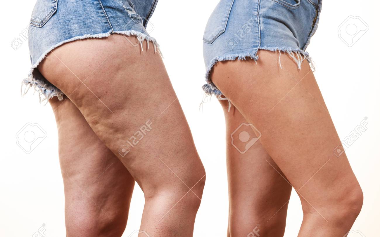 セルライトの有無にかかわらず女性の脚の太ももの比較 皮膚の問題 ボディケア 太りすぎとダイエットの概念 の写真素材 画像素材 Image
