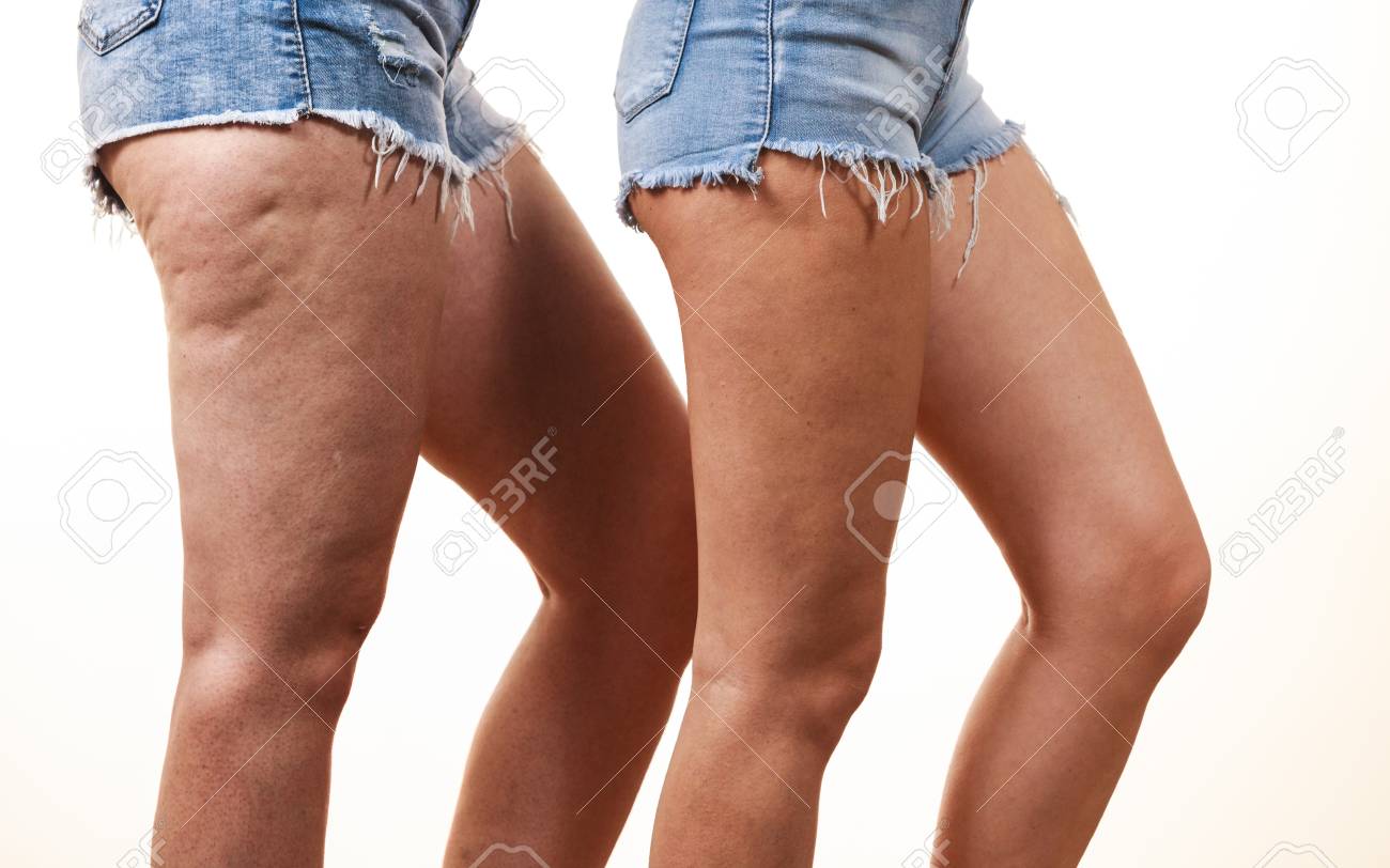 celulitis y shorts