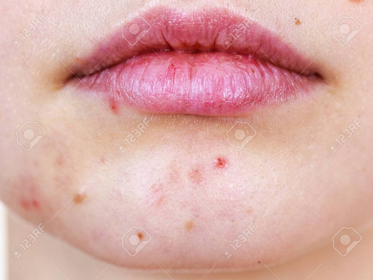 dry acne on face