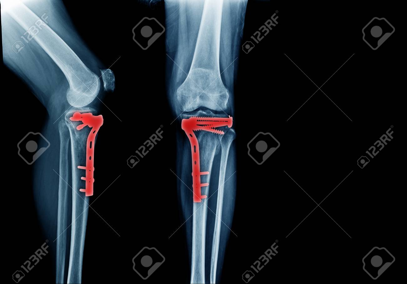 Fracture Tibia Bone And Post Operation Fixation Anterior And Stock Photo Picture And Royalty Free Image Image 101010642