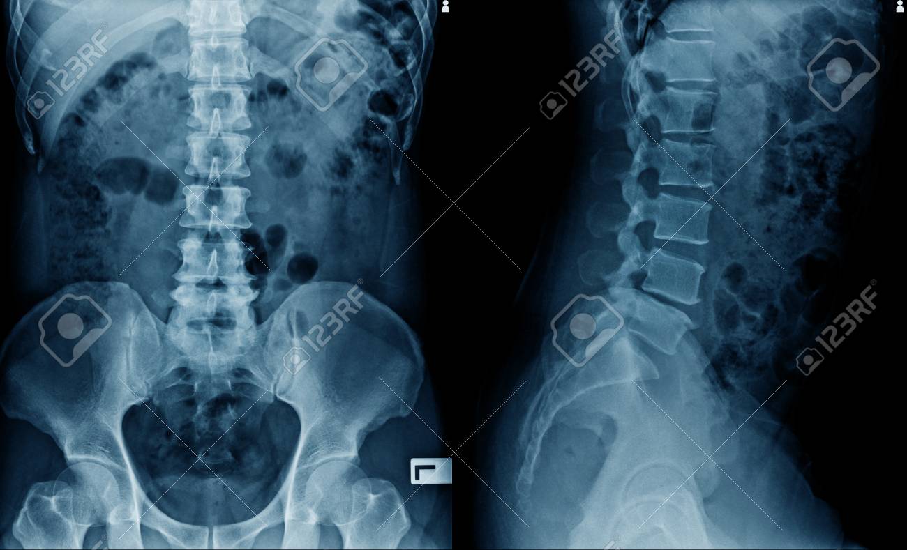 x-ray image of spine and hip joint AP/Lateral view - 119814779 x-ray image of spine and hip joint AP/Lateral view - 119814779