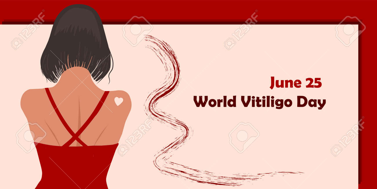 June 25 - World Vitiligo Day. Pigmentation disorders. Skin depigmentation. Vector illustration on the theme of rare diseases. Chronic skin disease. - 168914920 June 25 - World Vitiligo Day. Pigmentation disorders. Skin depigmentation. Vector illustration on the theme of rare diseases. Chronic skin disease. - 168914920
