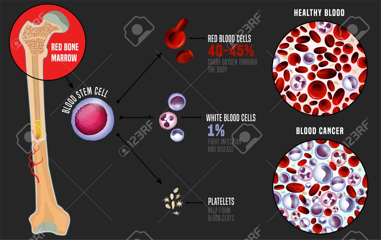 симптомы костного мозга. гемобластозы лейкозы. костные опухоли позвоночника. онкология костного мозга симптомы. симптомы костного мозга.