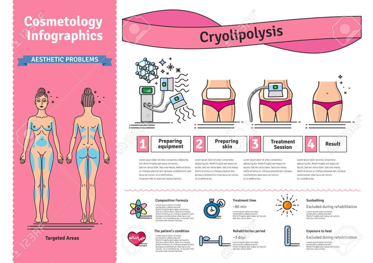 Vector Illustrated set with salon cosmetology Cryolipolysis treatment. Infographics with icons of medical cosmetic procedures for body. - 70962019 Vector Illustrated set with salon cosmetology Cryolipolysis treatment. Infographics with icons of medical cosmetic procedures for body. - 70962019
