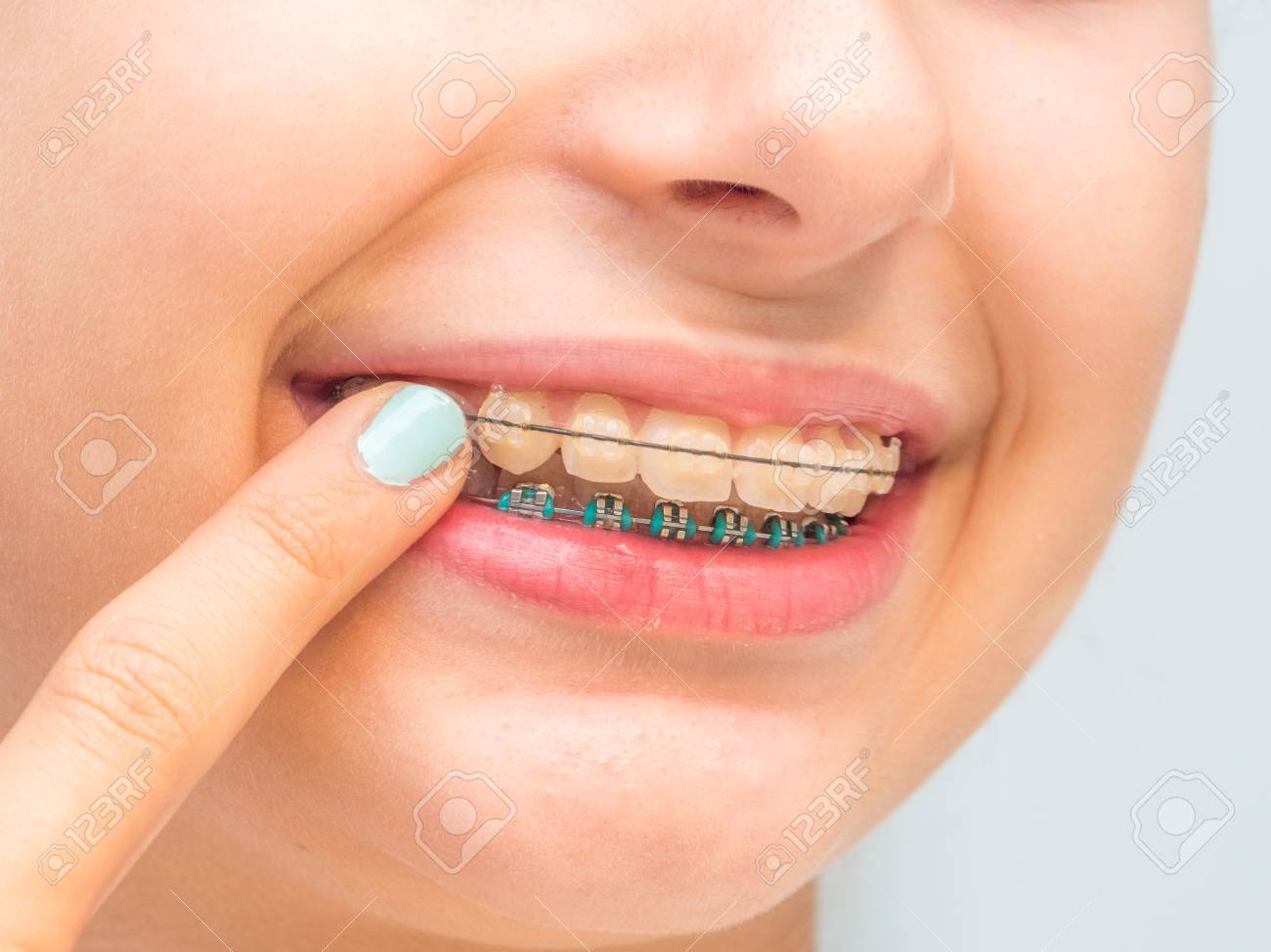 Ceramic braces. Features of ceramic braces Ceramic braces. Features of ceramic braces