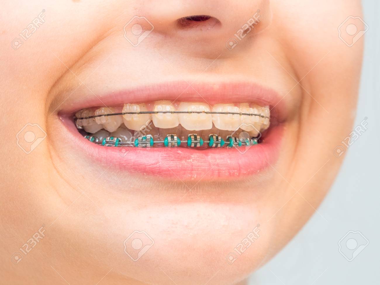 Ceramic braces. Features of ceramic braces Ceramic braces. Features of ceramic braces