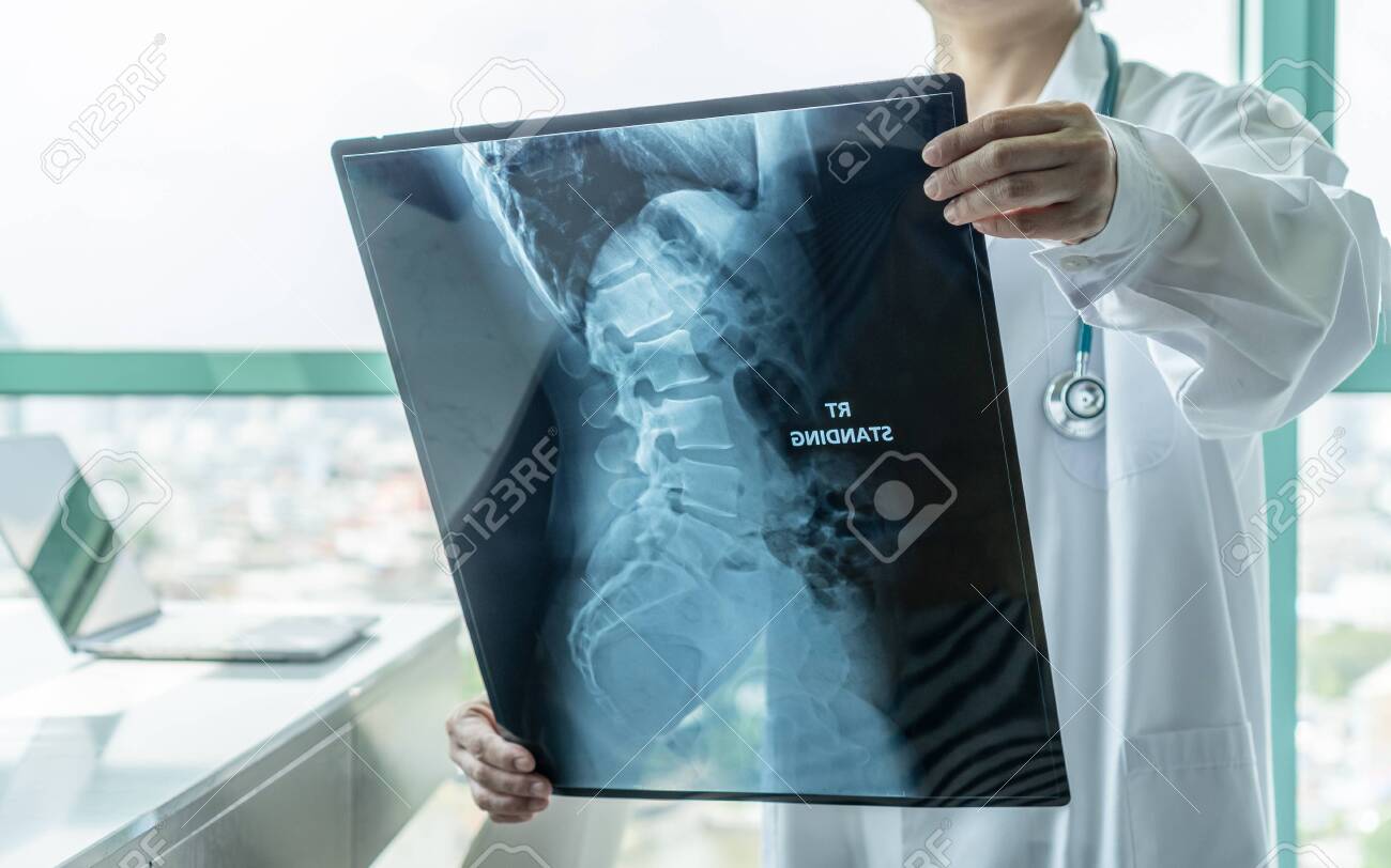 Surgical doctor looking at radiological spinal x-ray film for medical diagnosis on patient’s health on spine disease, bone cancer illness, spinal muscular atrophy, medical healthcare concept - 132026778 Surgical doctor looking at radiological spinal x-ray film for medical diagnosis on patient’s health on spine disease, bone cancer illness, spinal muscular atrophy, medical healthcare concept - 132026778