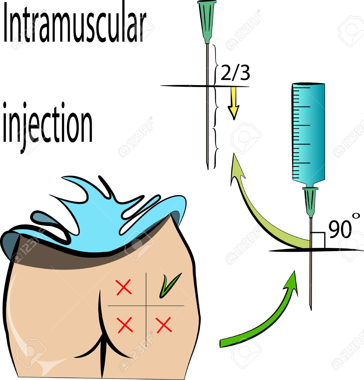 illustration of rules intramuscular injection royalty free cliparts