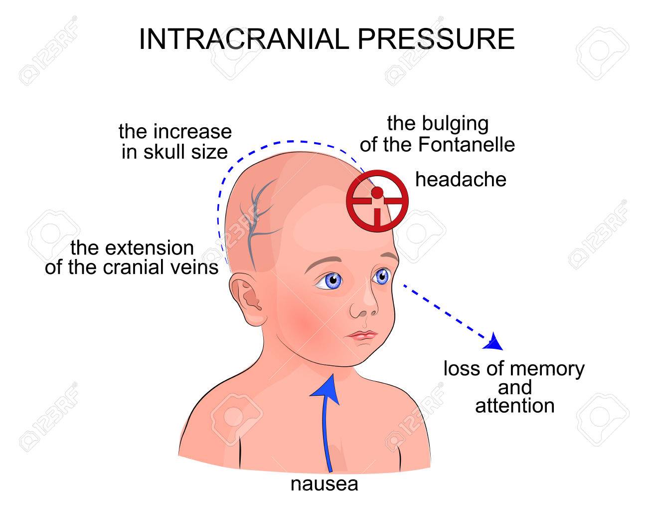 Illustration Of Symptoms Of Intracranial Pressure In Children Royalty Free Cliparts Vectors And Stock Illustration Image 56937885