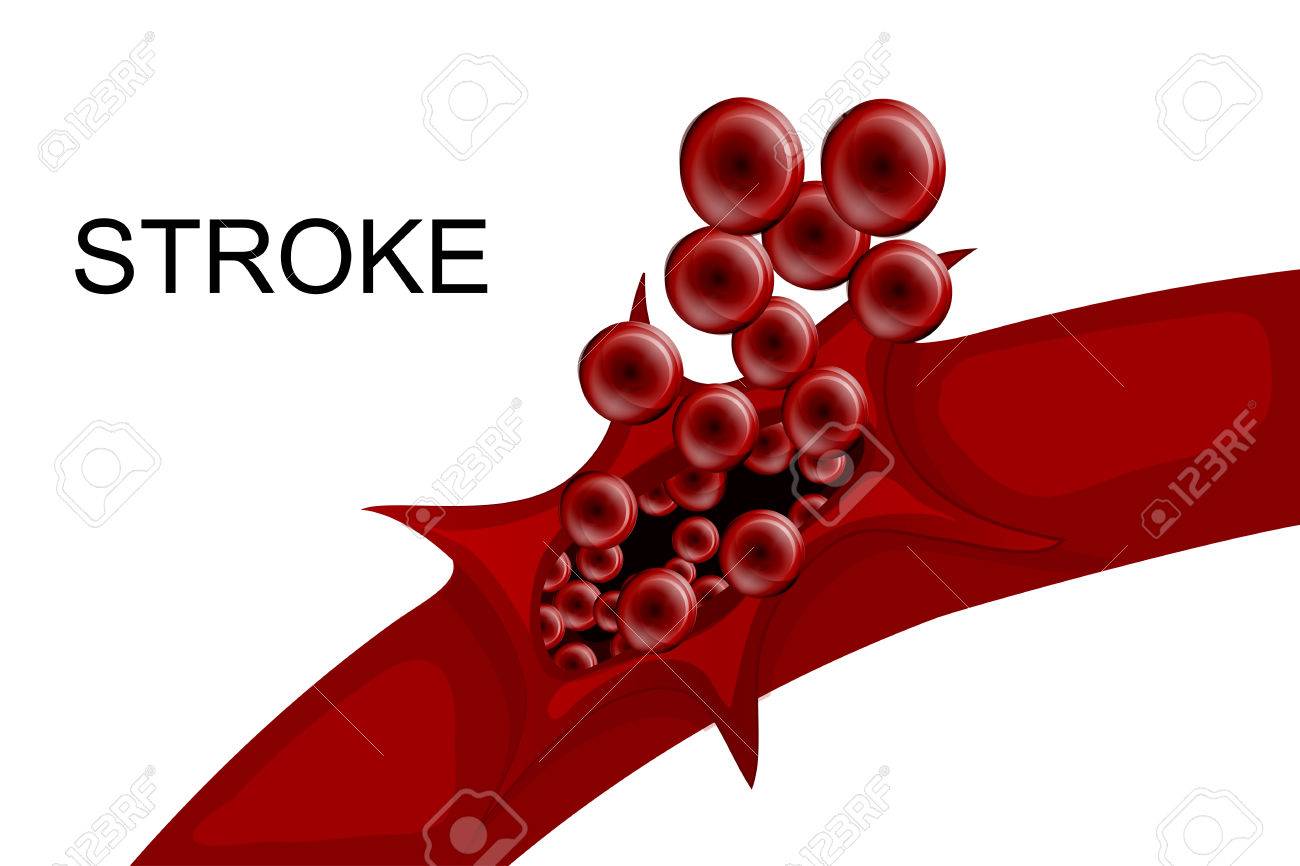 illustration of a rupture of the vessel. hemorrhagic stroke. insult - 56937943 illustration of a rupture of the vessel. hemorrhagic stroke. insult - 56937943