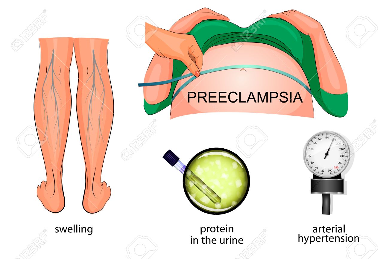 the symptoms of eclampsia during pregnancy: swelling of the feet, hypertension and protein in the urine - 58384541 the symptoms of eclampsia during pregnancy: swelling of the feet, hypertension and protein in the urine - 58384541