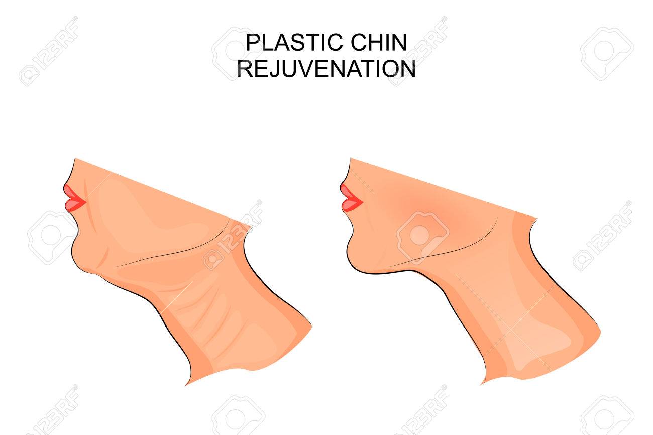 illustration of a chin before and after plastic surgery - 63512493 illustration of a chin before and after plastic surgery - 63512493
