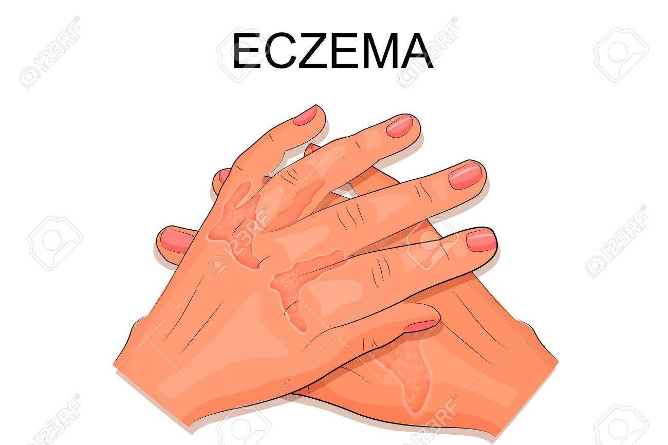 Illustration Of Hands Of A Patient Suffering From Eczema Royalty Free Cliparts Vectors And Stock Illustration Image 64213180