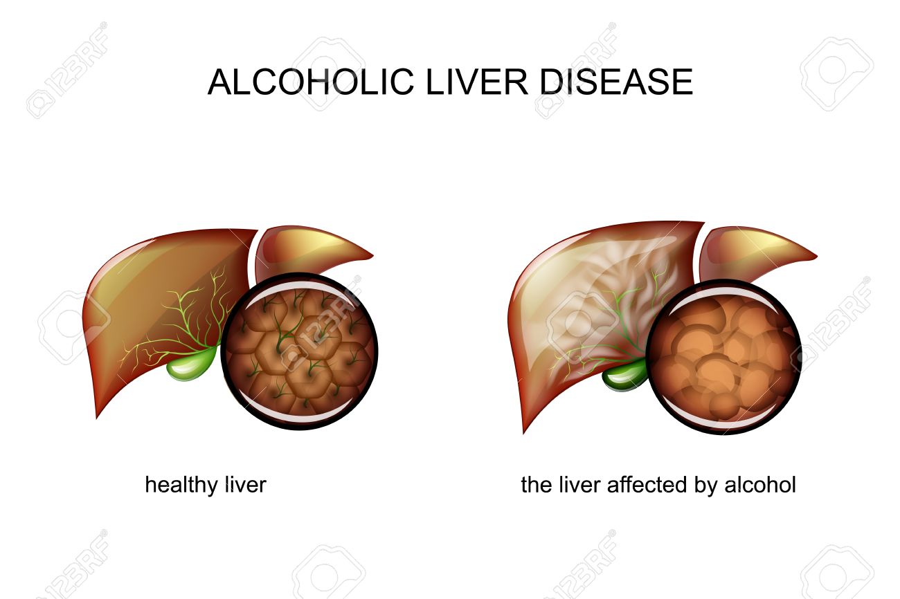Image result for alcoholic liver vs healthy liver