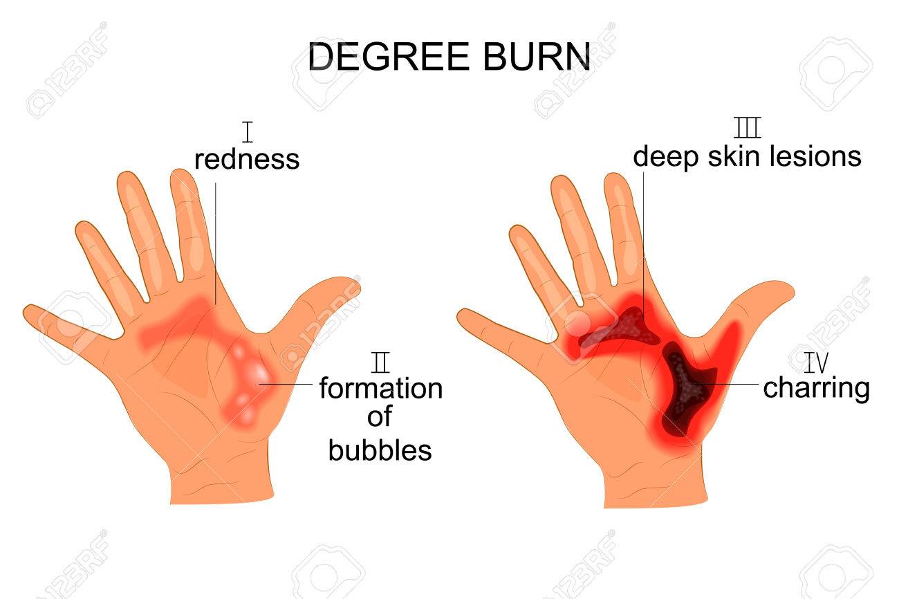 vector illustration of burn the hands of four degrees - 72205095 vector illustration of burn the hands of four degrees - 72205095