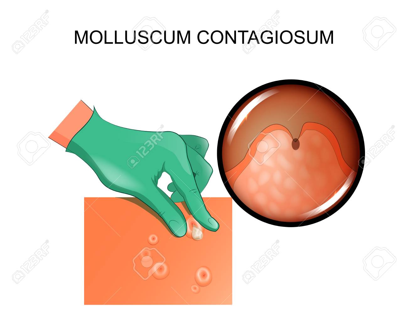 la ulcera cervical es contagiosa