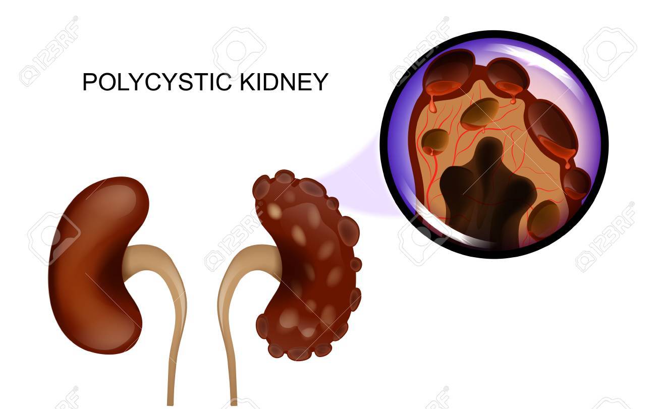 健康な腎臓と腎嚢胞に苦しんでのベクトル イラストのイラスト素材 ベクタ Image 54 健康な腎臓と腎嚢胞に苦しんでのベクトル イラストのイラスト素材 ベクタ Image 54