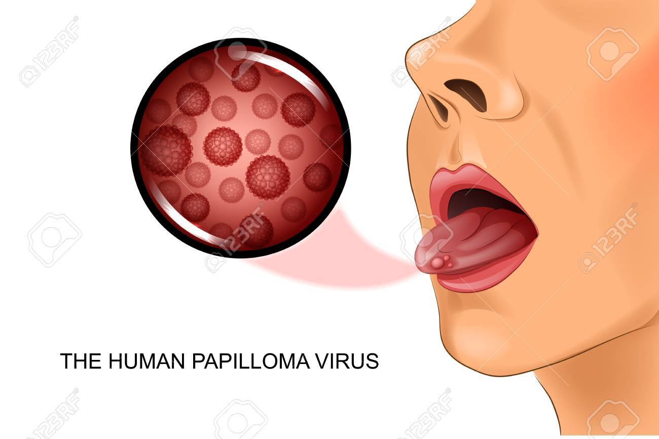 Ilustración Vectorial Del Virus Del Papiloma Humano En La Lengua  Ilustraciones Svg, Vectoriales, Clip Art Vectorizado Libre De Derechos.  Image 88596065.