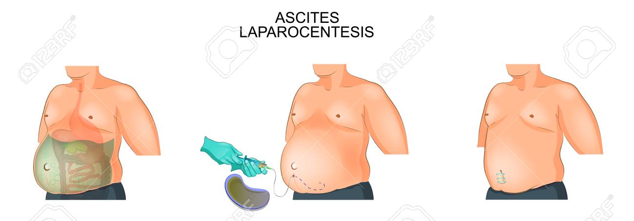 Vector illustration of a man suffering from ascites. - 88805443 Vector illustration of a man suffering from ascites. - 88805443