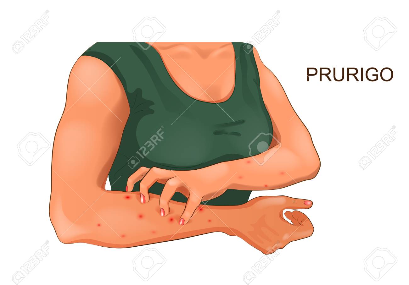 vector illustration of allergic itching of the skin - 114782405 vector illustration of allergic itching of the skin - 114782405
