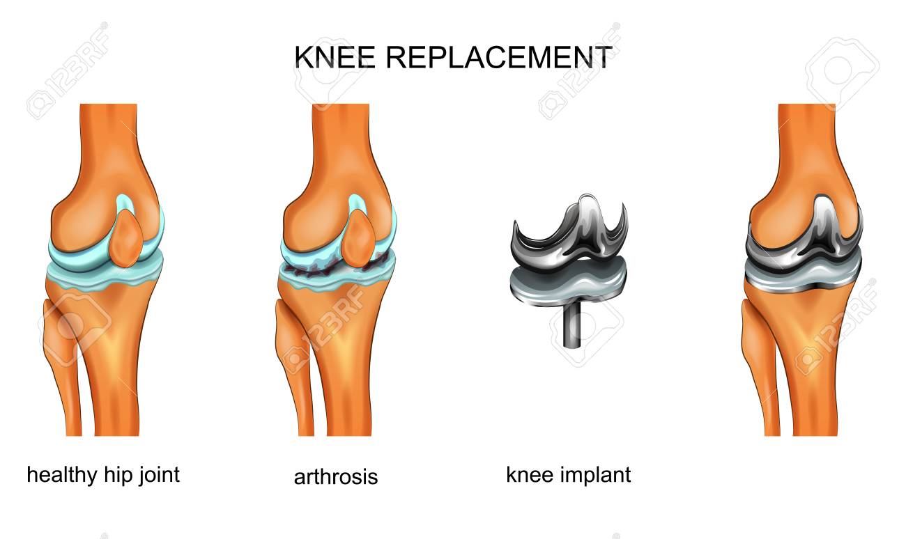 vector illustration of a total knee replacement - 106289894 vector illustration of a total knee replacement - 106289894