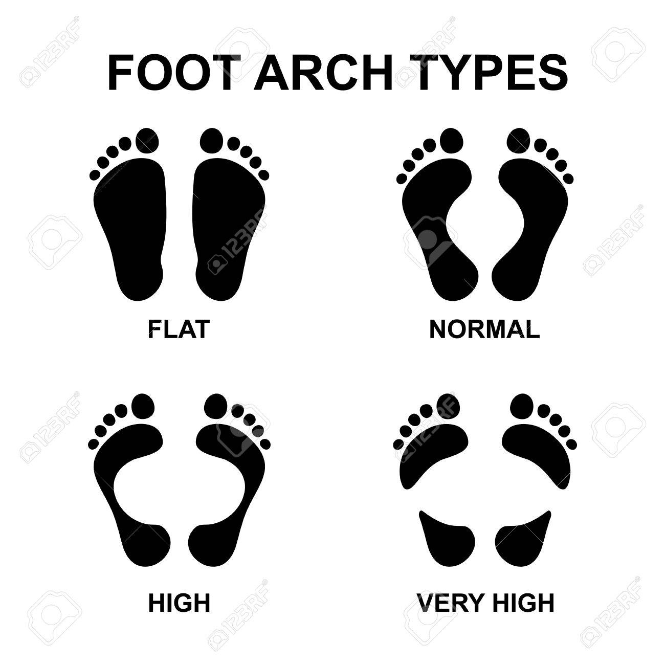 very high arches