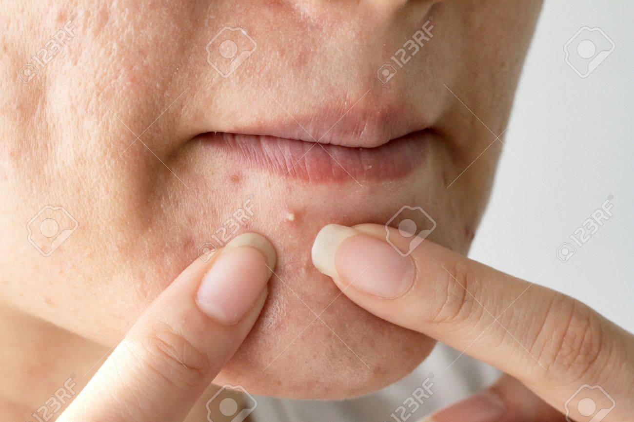 pimple prone skin