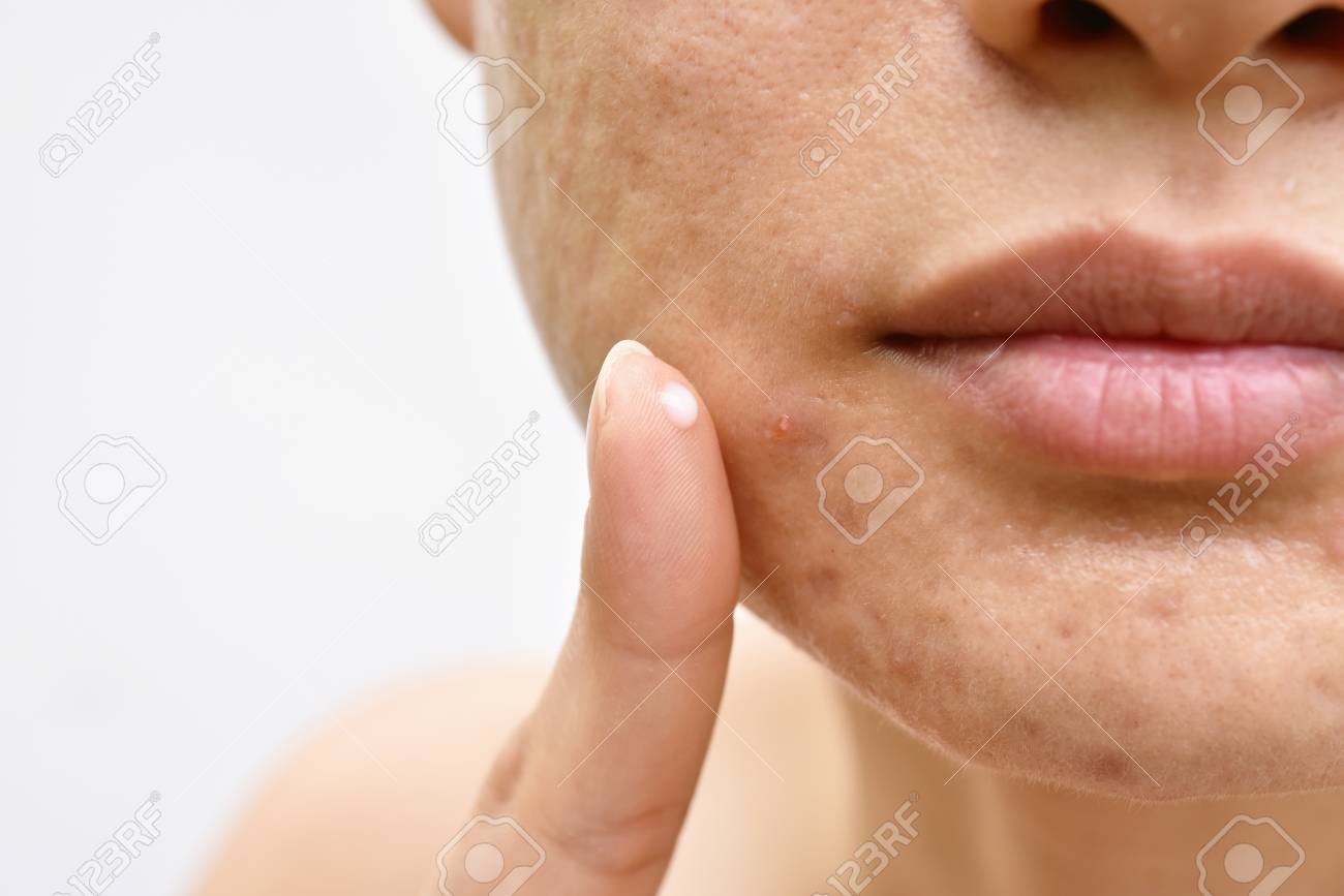 acne cream face