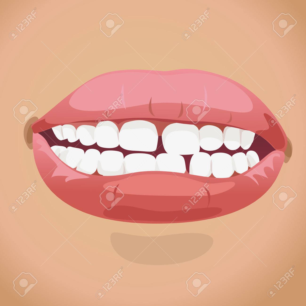 Open Mouth To Show Big Gap Between Teeth Royalty Free SVG, Cliparts, Vectors, And Stock Illustration. Image 26077734. Open Mouth To Show Big Gap Between Teeth Royalty Free SVG, Cliparts, Vectors, And Stock Illustration. Image 26077734.