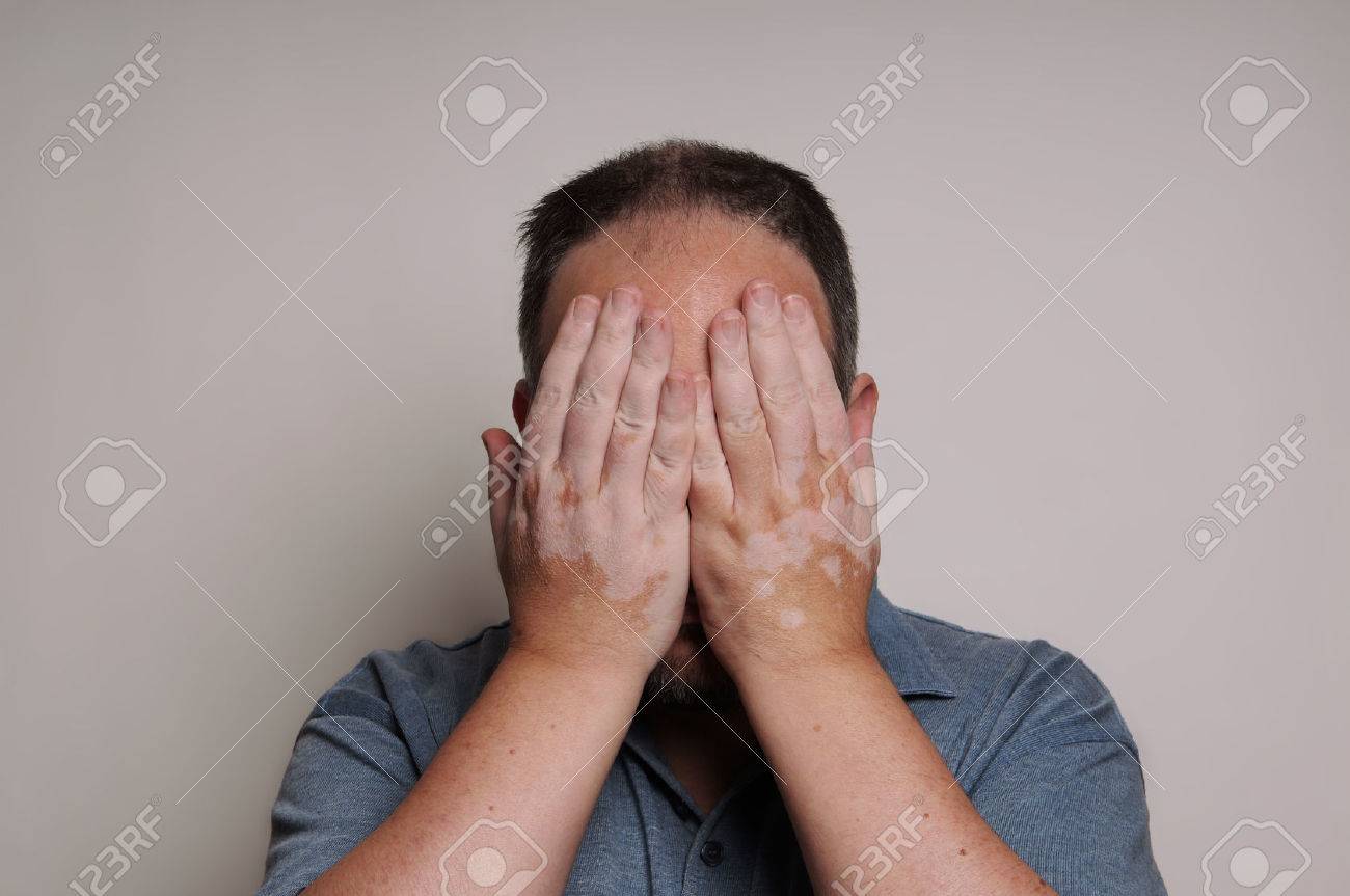 彼の顔を隠して白斑の肌の状態によって影響を受ける人 の写真素材 画像素材 Image