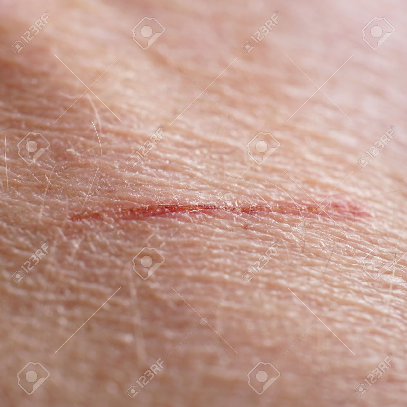 human scratch treatment