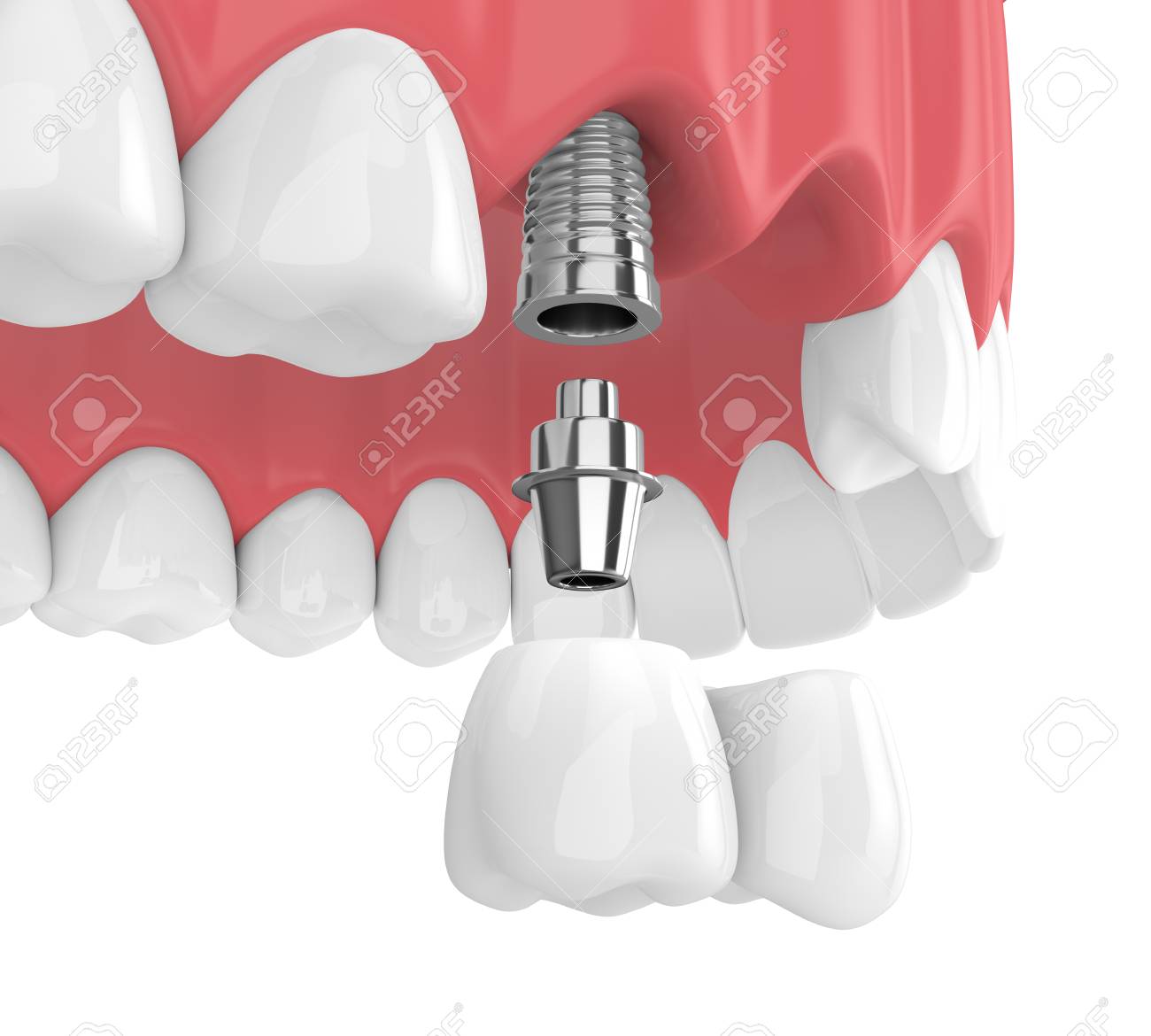 cantilever bridge dental