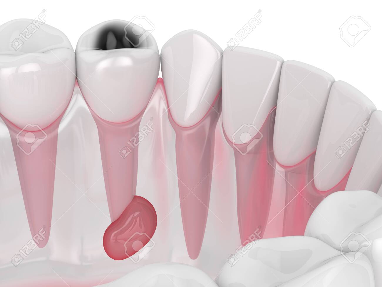 3d render of jaw with tooth cavity and cyst. Dental problem concept. - 134438432 3d render of jaw with tooth cavity and cyst. Dental problem concept. - 134438432