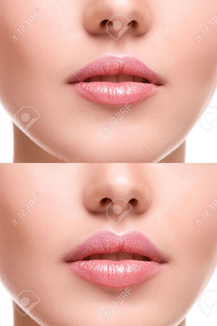 Female lips before and after augmentation - 44235153 Female lips before and after augmentation - 44235153