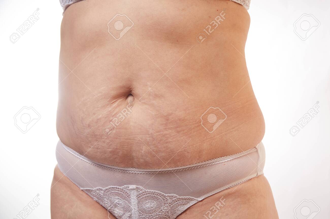 Legs And Belly Of A 40 Year Old Woman With Stretch Marks Cellulite Stock Photo Picture And Royalty Free Image Image 146037687