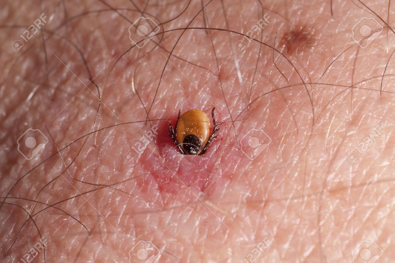 tick burrowing in human skin stock photo picture and royalty free