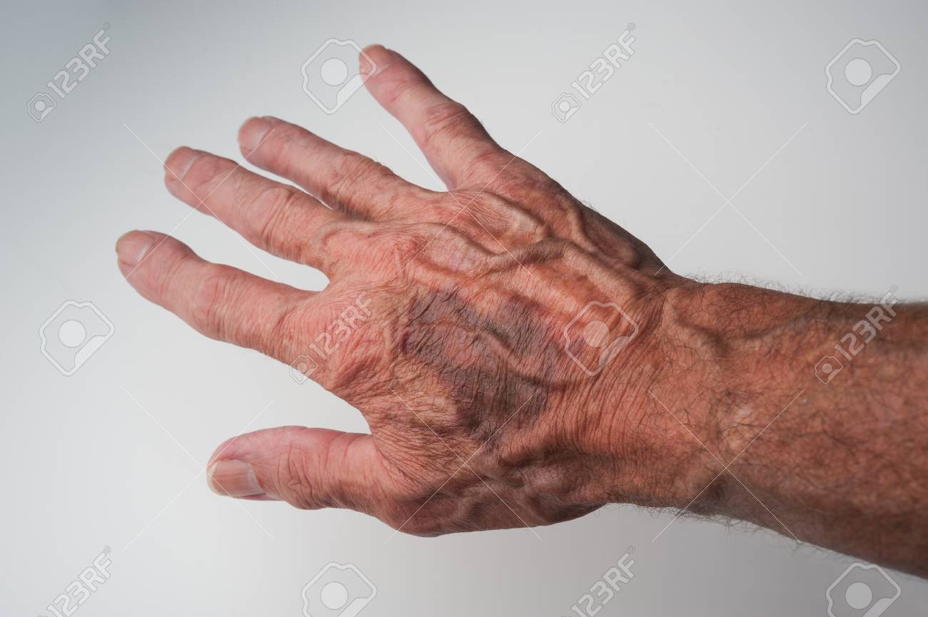 Bruises And Blood Spots Under The Skin That Occur On Older People Stock Photo Picture And Royalty Free Image Image 8559