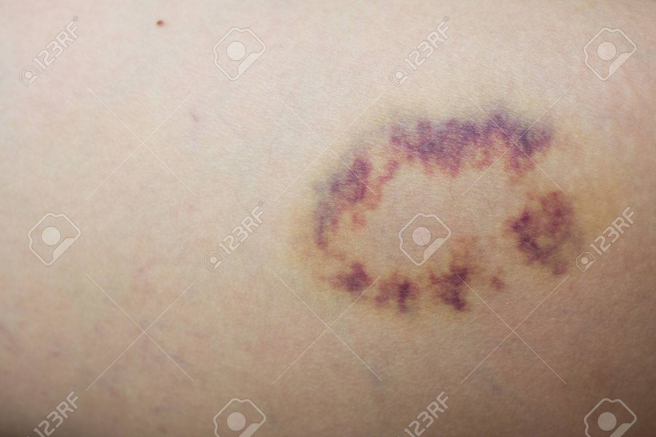 Closed up violet lesion on skin - 64555493 Closed up violet lesion on skin - 64555493