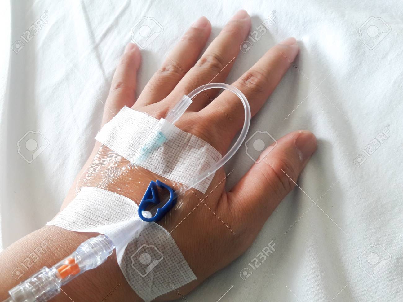 Patient hand with the tube of normal saline infusion on white cloth background - 88437386 Patient hand with the tube of normal saline infusion on white cloth background - 88437386