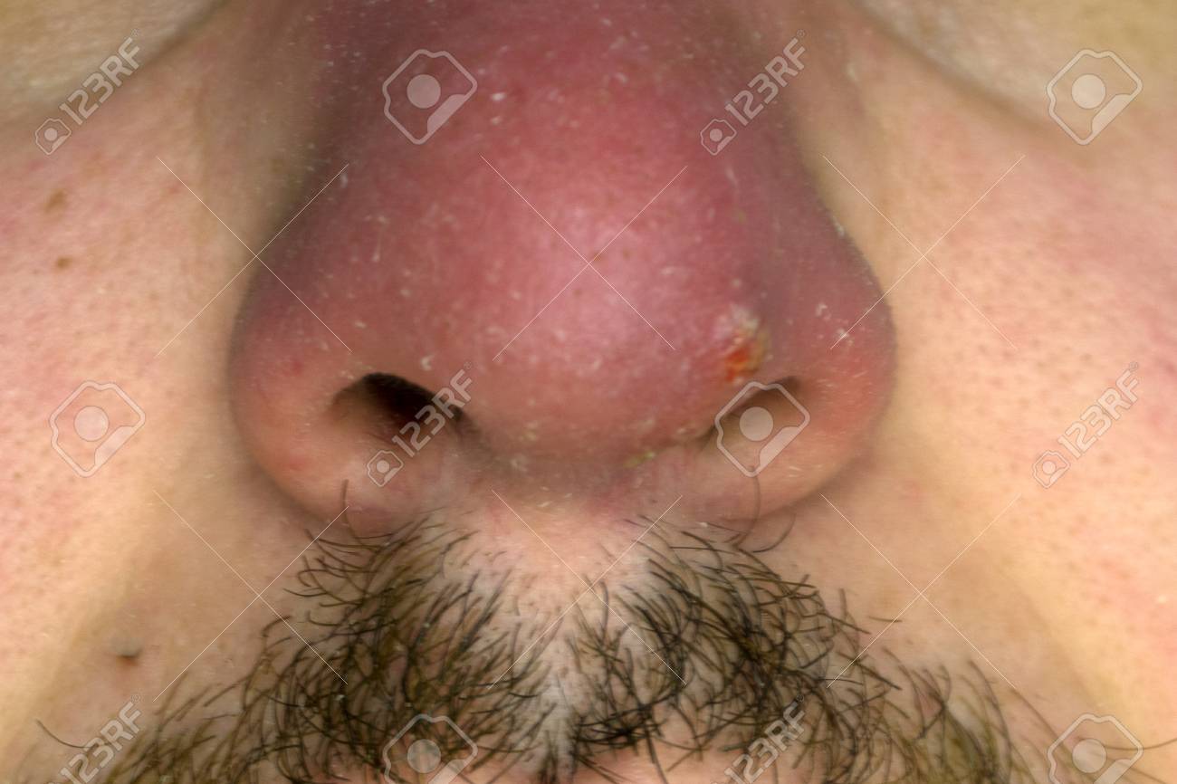 この不幸な苦しみの若い男性は 彼の鼻に悪い赤い日焼けを得て 赤い皮膚は今剥離しています の写真素材 画像素材 Image