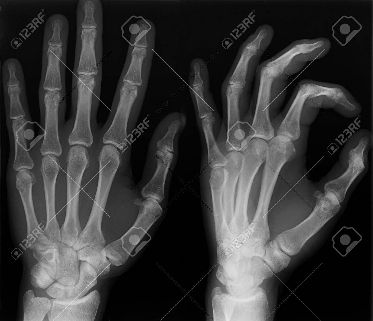 radiografía de la mano izquierda disparar en dos versiones fotos