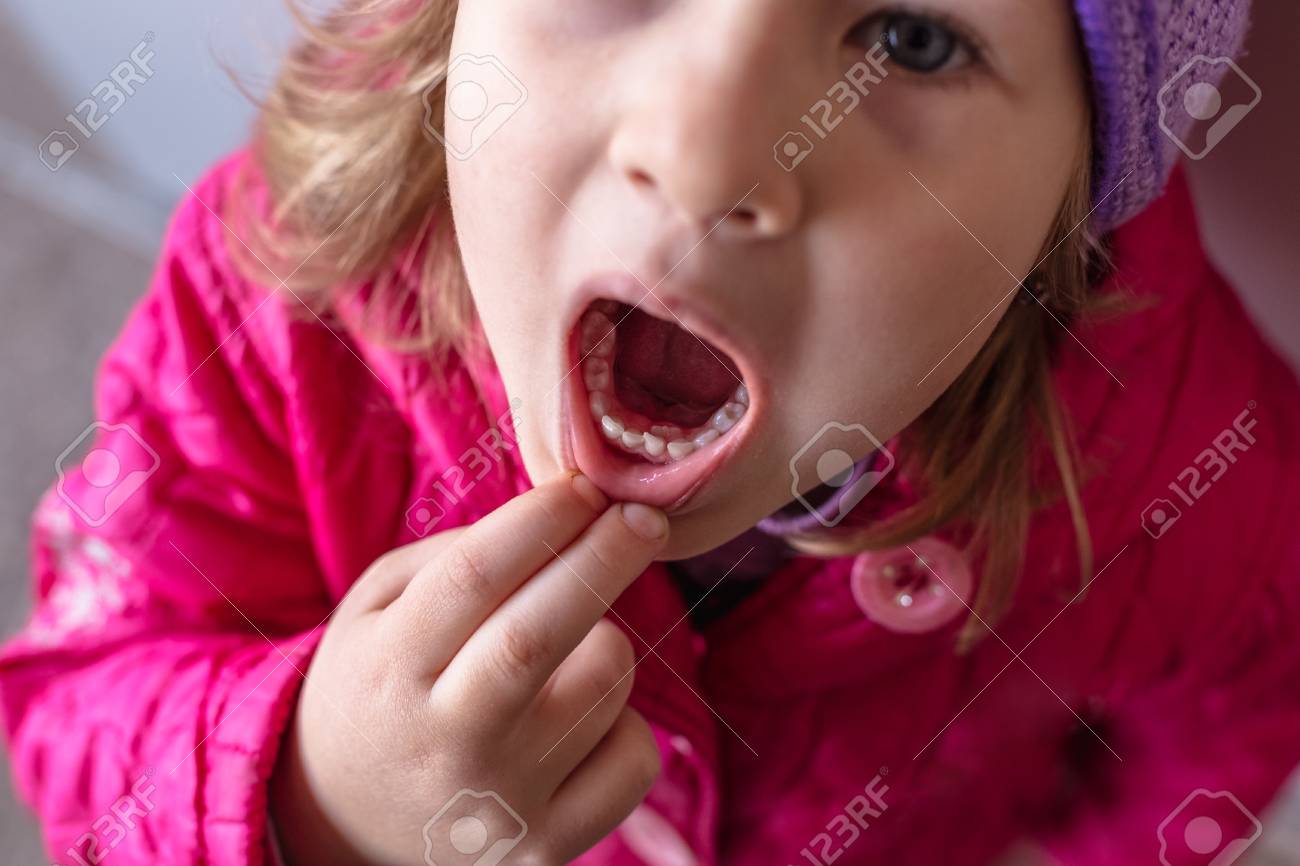 Dents Permanentes Adultes Venant Derriere Les Dents De Bebe Dents De Requin Bouche Ouverte De Petite Fille Banque D Images Et Photos Libres De Droits Image