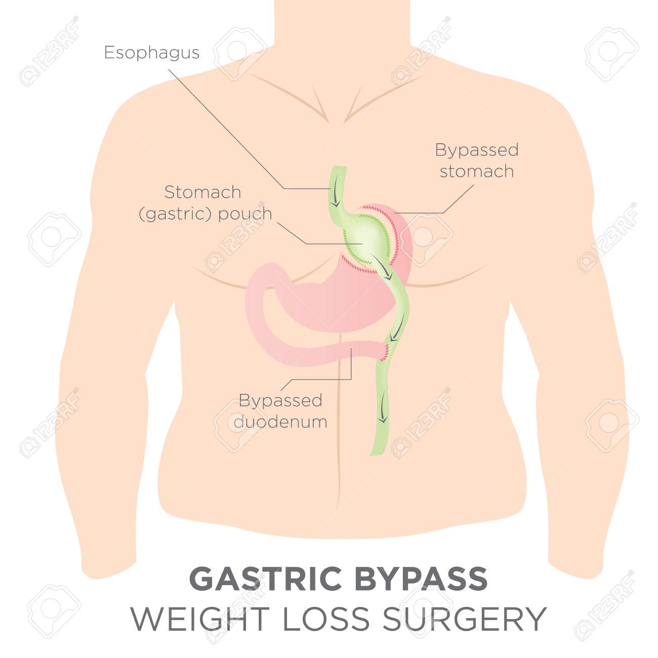 perdere peso con bypass gastrico