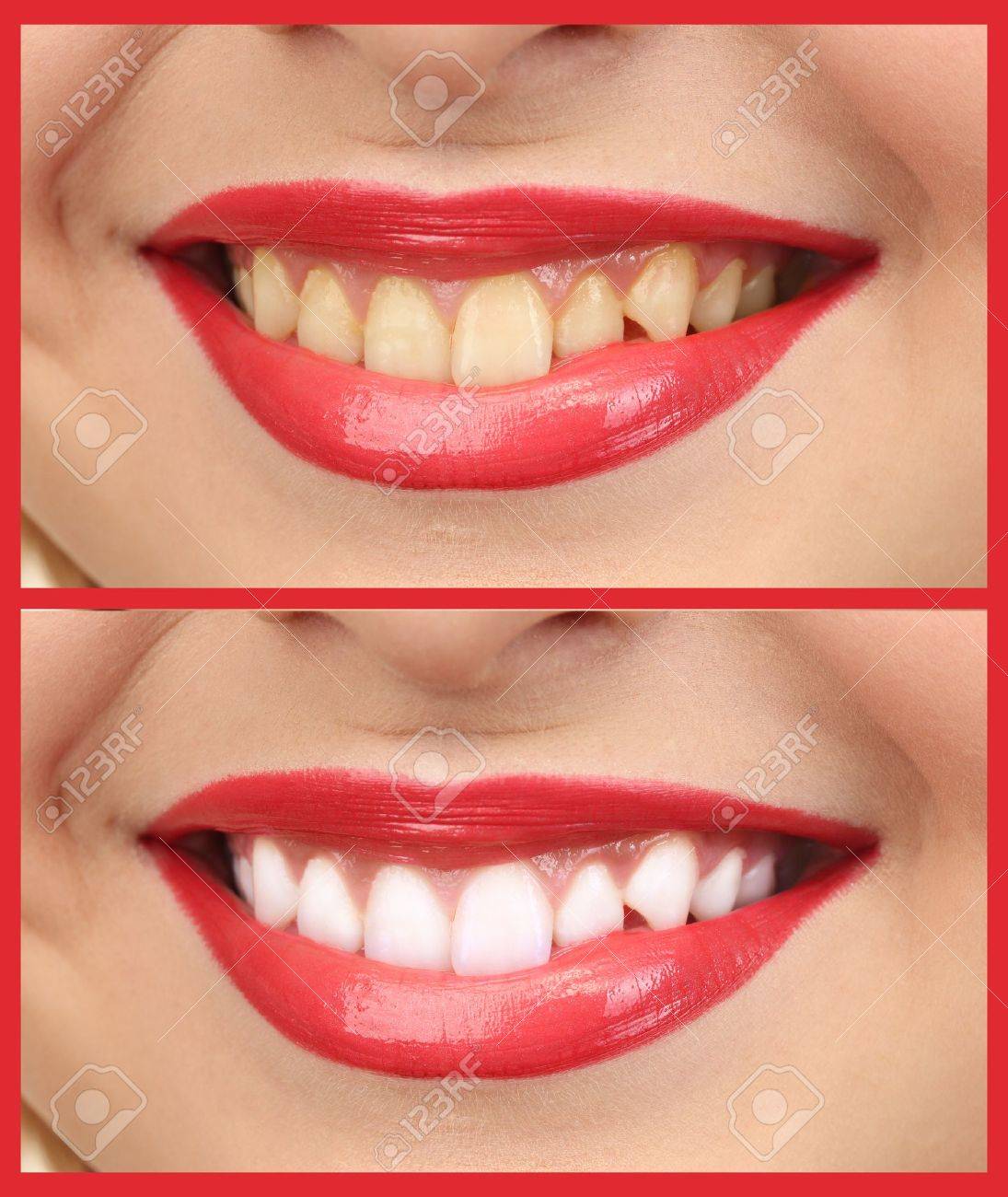 Women smile with teeth: whitening - bleaching treatment , before and after - 22023964 Women smile with teeth: whitening - bleaching treatment , before and after - 22023964
